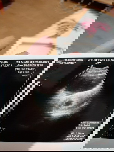 Hamil 7Week namun janin belum terlihat di kantung kehamilan