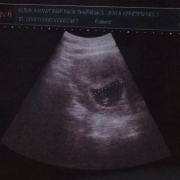 9 minggu bentuknya seperti ini .. sayabingung  ini artinya janinnya berkembang atau tidak