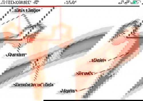 mau nanya soal tuba falopi yg tersumbat