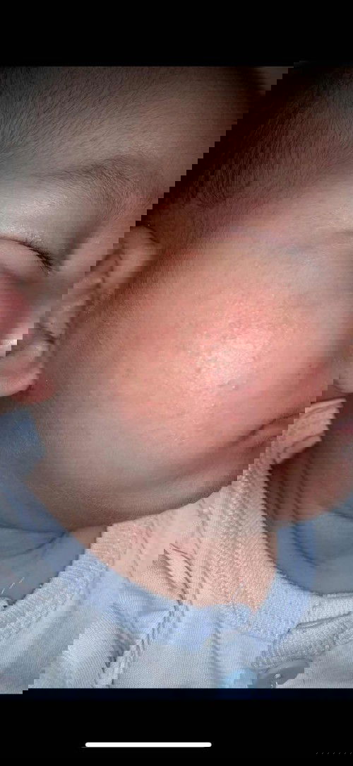 Da bé 2 tháng tuổi bị mụn, phải làm sao