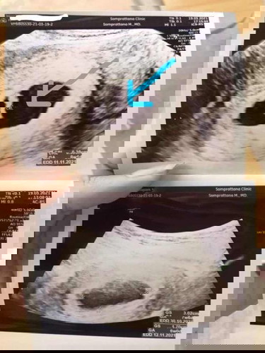 มีถุงตั้งครรภ์แต่ไม่เจอเด็กและหัวใจ