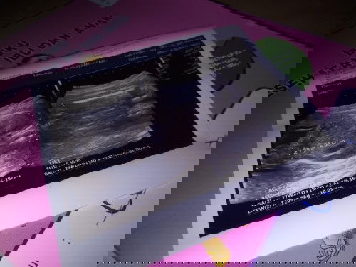 Janin kecil / berat janin kurang