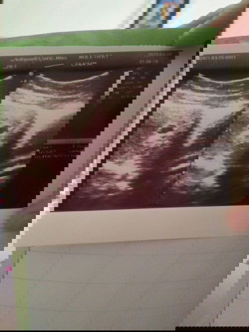 Seputar ancaman keguguran