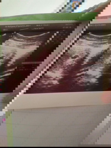 Seputar ancaman keguguran