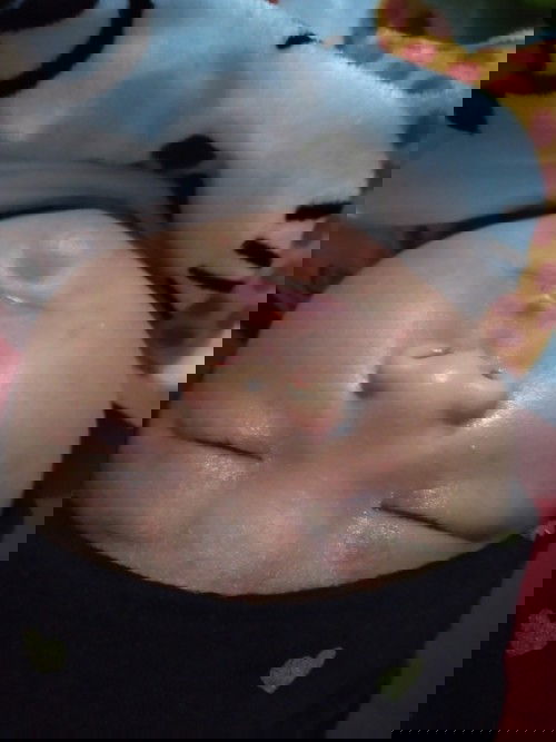 Beruntus di bayi usia 4 hari