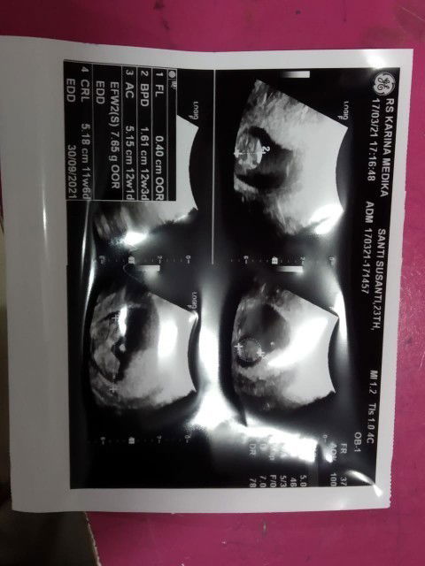 Usia Kehamilan HPHT dengan Usia Janin dikandungan berbeda