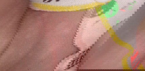 Kulit bayi bercak putih