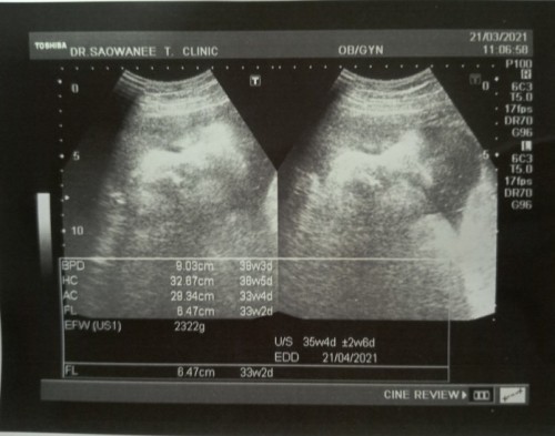 37 สัปดาห์ ลูกน้ำหนักน้อยจัง