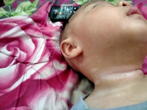 Bayi 3 BLN ada bercak putih di leher
