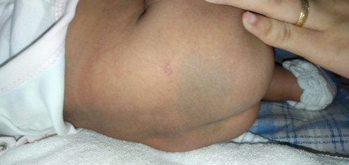 Normal lang po ba ganito color ng pwet ng baby? 1m&10d baby girl. Salamat.