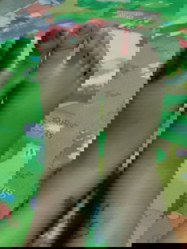 เริ่มมีอาการเท้าบวม!!