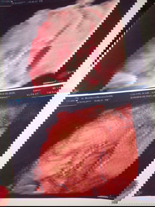 30w5D wajh dd di tutupin tali pusat