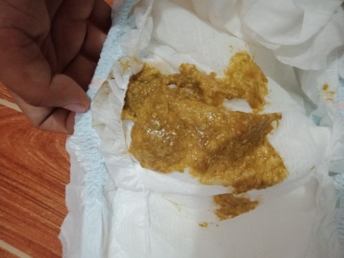 Hello po normal po ba na mayroon ganito sa stool ng baby ko?