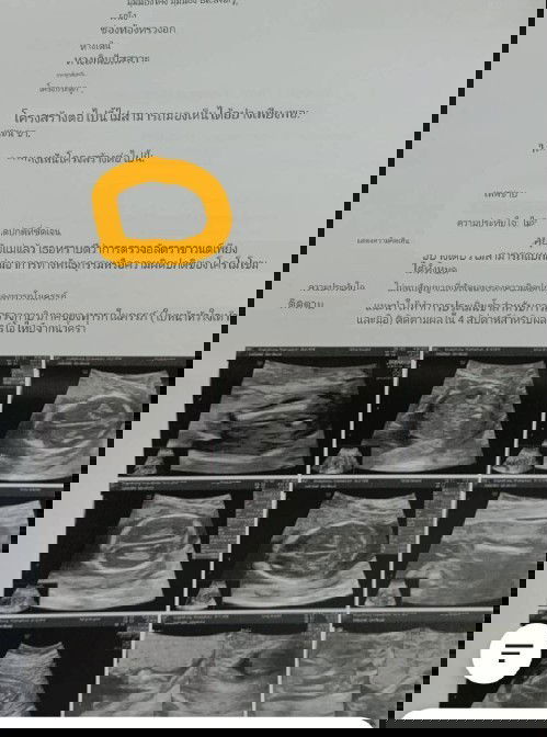 ทีมเจาะน้ำคร่ำ เพราะคุณแม่อายุเกิน 35 ปีค่ะ