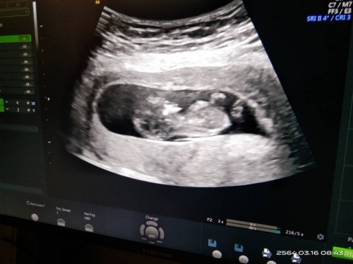 หมันหลุดเกิดเเล้ว12สับดาทำหมัน3ปีดีไจที่สุด