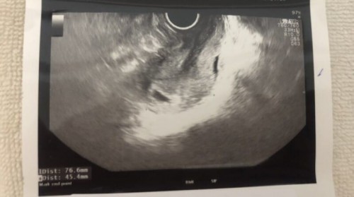 แม่เสี่ยงท้องลม #ท้องสองค่ะ 😞