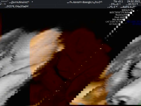 H-16 SC ternyata positif covid