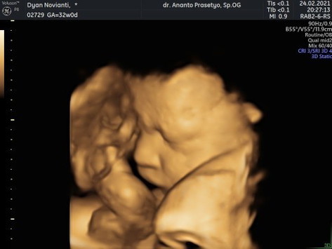 H-16 SC ternyata positif covid