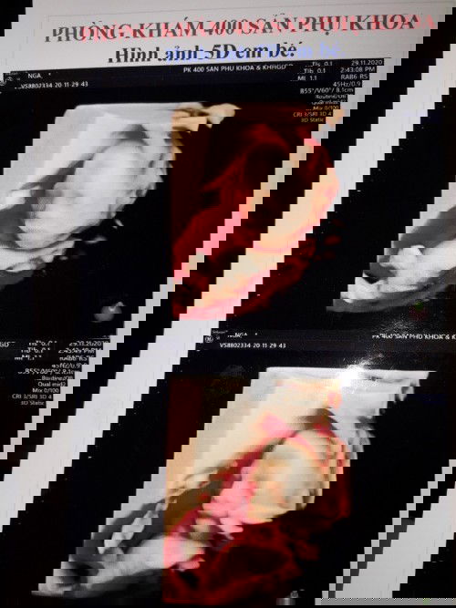 Con mình đc 32 tuần 1 ngày co 1950kg vậy có nhỏ lắm k ạ