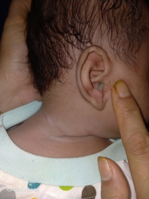 Telinga banyi keluar seperti nanah