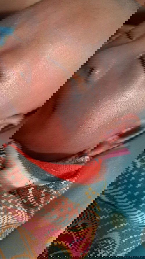 Ruam merah pada bayi