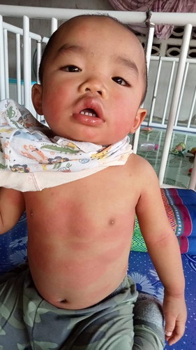 น้องมีผื่นแบบนี้ค่ะ
ตอนเริ่มหน้าบวมตาบวม
ไปหาหมอ...หมอสั่งให้หยุดยาทุกตัวกินแต่ยาแก้แพ้
ิ