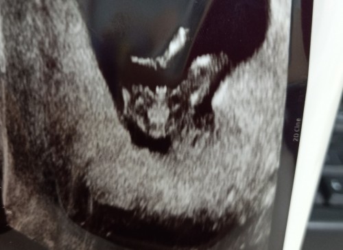 แบบนี้จะเป็นเพศไหนค่ะ 12+5wk