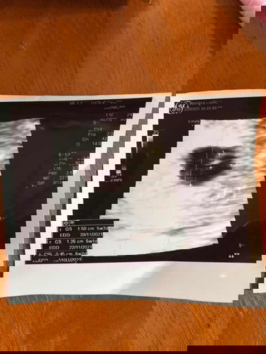 อันตร้าซาวด์ ยังไม่เจอน้อง