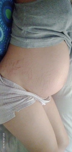 Stretch marks