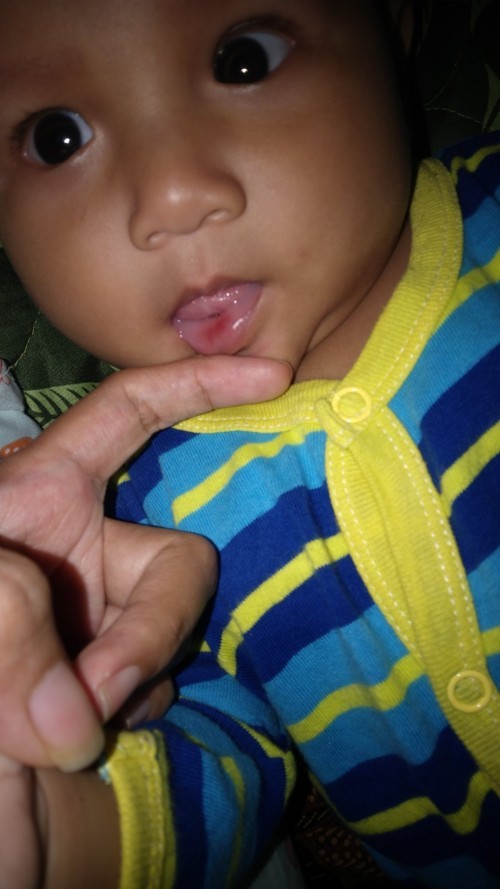 Bibir anak ada bercak merah