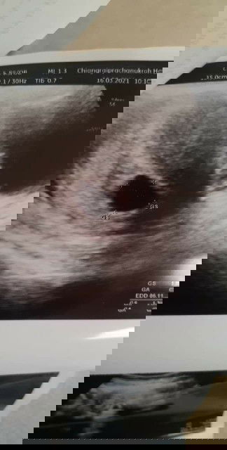 ซาวตอน6วีคไม่เจอตัวเเละหัวใจ มีโอกาส ท้องลมสูงไหมค่ะ