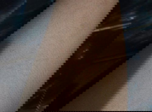 Alergi tangan dan kaki