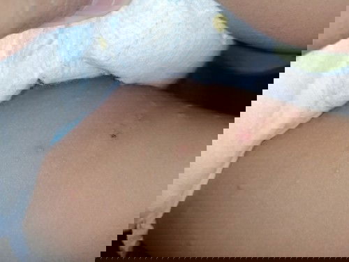 Rashes na butlig na parang may tubig