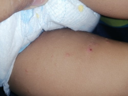 Rashes na butlig na parang may tubig