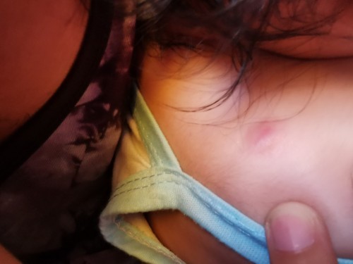 Lumps on my baby's right shoulder.Anyone here po na Naka experience na my ganito ang baby po..