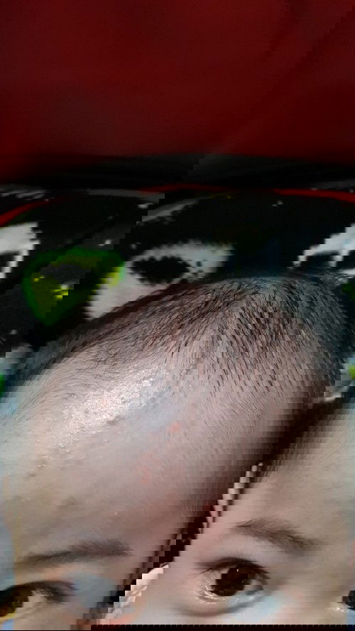 Keringat buntet di dahi kadang keluar nanah