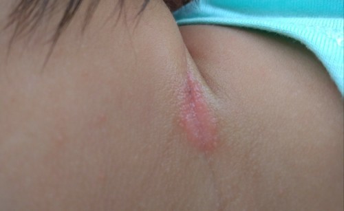 Baby Skin^