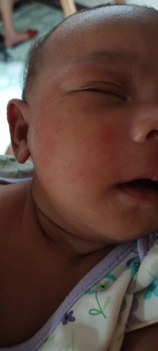 Rashes of the baby