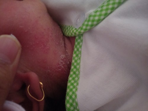 Keringet buntet atau iritasi?