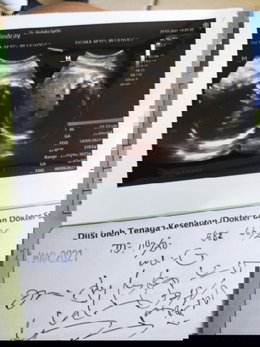 "Sudah masuk panggul".