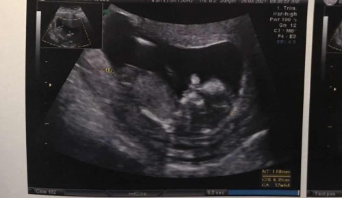 ตั้งครรภ์13w คุณหมอแจ้งผู้หญิง80%