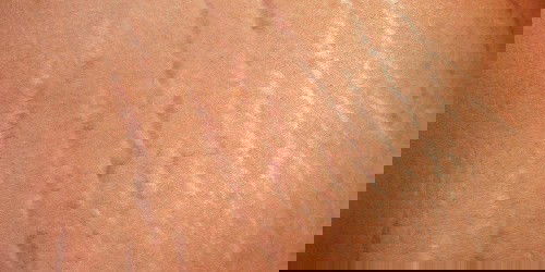 Stretch marks