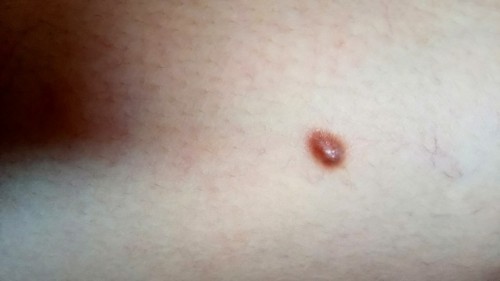 Warts o hindi?
