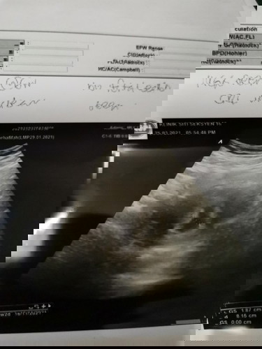 Still tak nampak baby and heartbeat