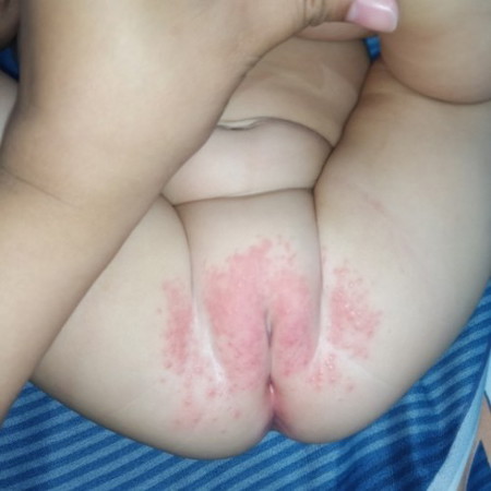 Rashes problem