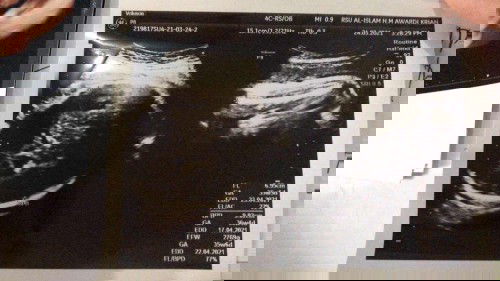 Hasil USG RSI Mawardi