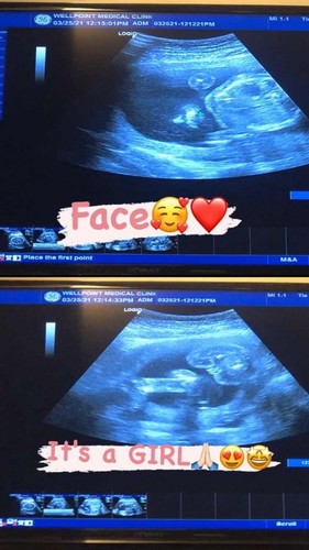 CONGENITAL ANOMALY SCAN (CAS UTZ)🥰