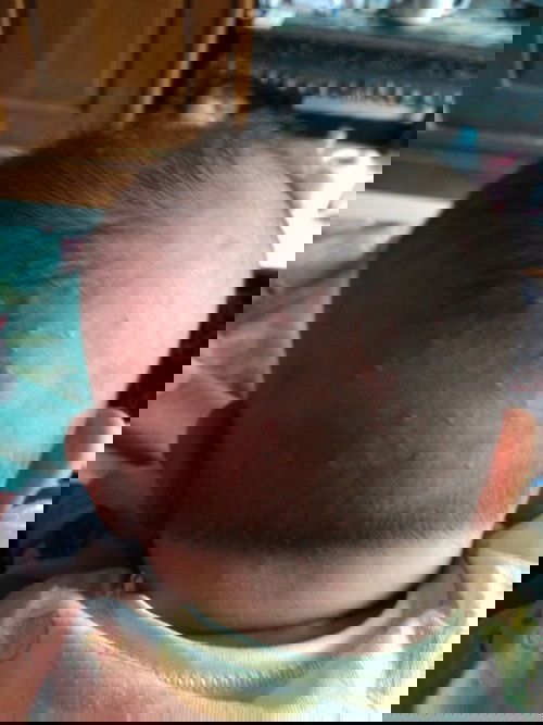 Bintil di kepala bayi