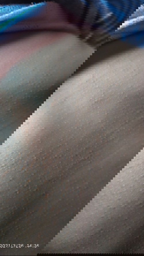 Bintik2 di punggung dan dada anak 2 tahun