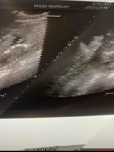 แม่ๆรู้เพศน้องตอนกี่วีคคะ